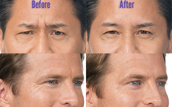 Male Botox before and after photos